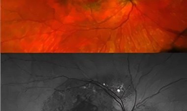 A New Genetic Eye Disease Has Been Discovered