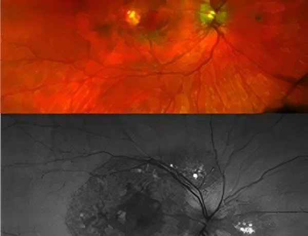 A New Genetic Eye Disease Has Been Discovered