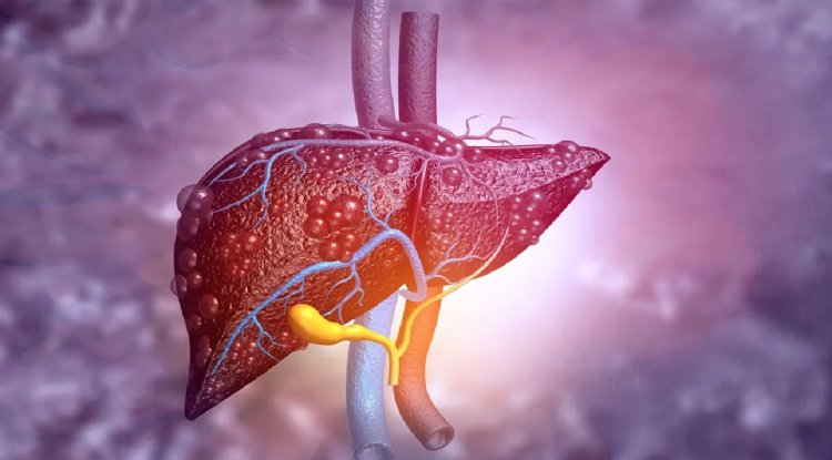 Sensor Can Detect Scarred or Fatty Liver Tissue to Help Prevent Liver Failure